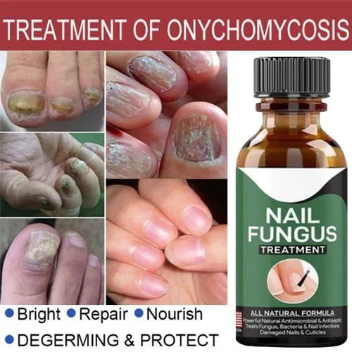 Fast Nail Fungal Treatment Gel – Repair Essence for Damaged Nails