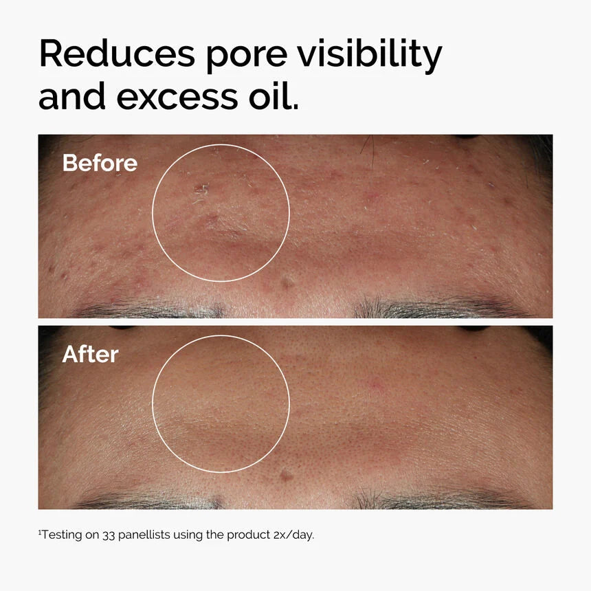 The Ordinary Niacinamide 10% + Zinc 1% Serum – Oil Control & Clear Skin Formula (30ml)